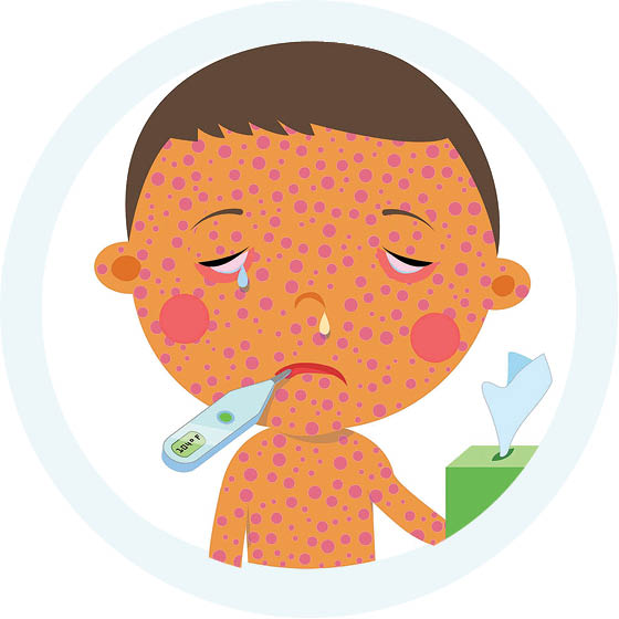 نگرانی جهانی از شیوع سرخک