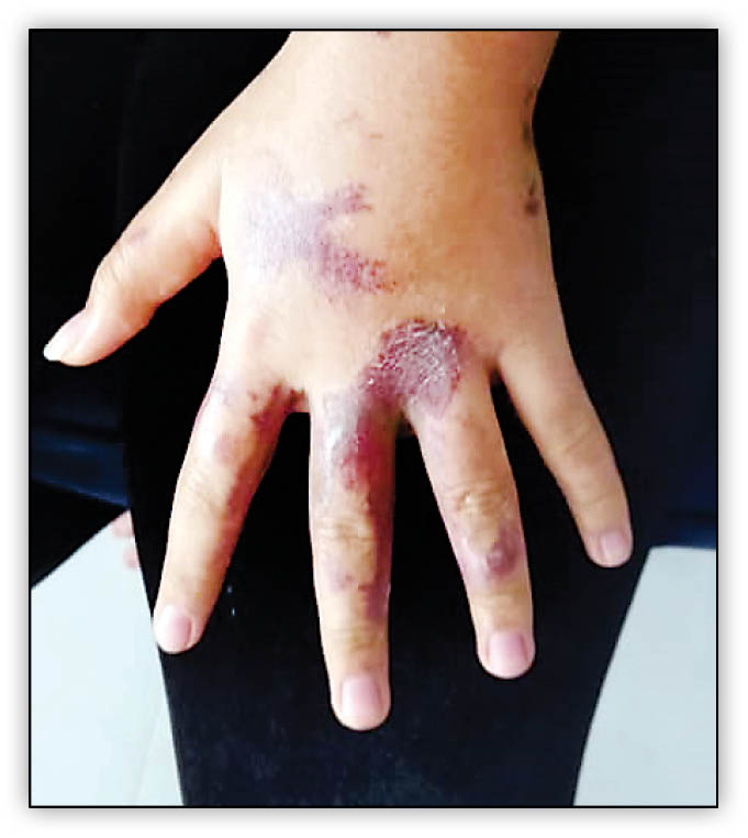 ناگفته‌های زنی که در شاهین‌شهر طعمه مرد اسیدپاش قرار گرفته بود