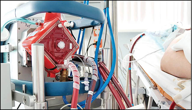 کاهش تلفات کرونا با اکسیژن‌رسانی خارجی به خون