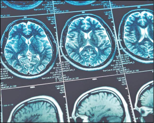 عوارض کرونا 20سال مغز را پیرتر می‌کند