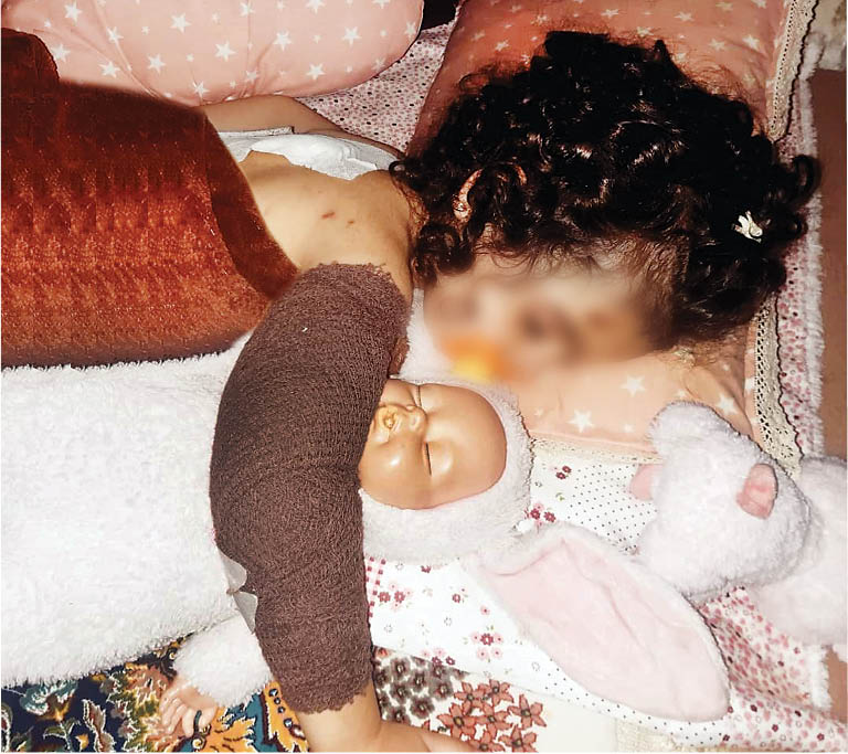 حمله خونین سگ‌های ولگرد به دختر 3ساله