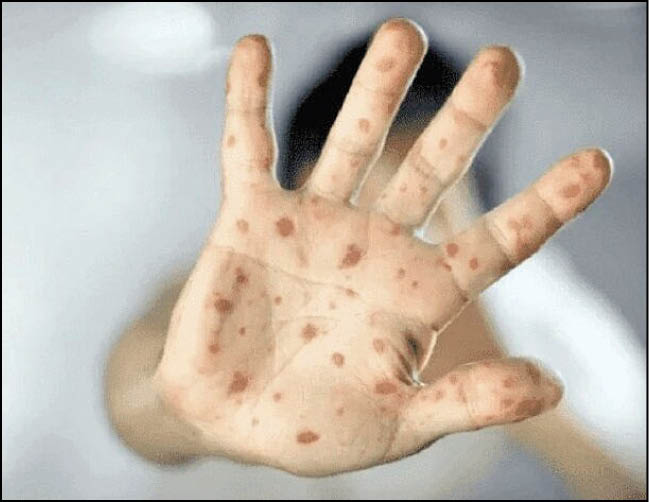 ۳ مورد تست آبله میمونی در ایران منفی شد