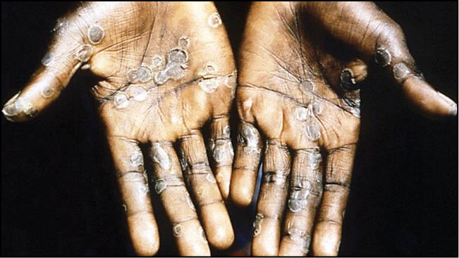 احتمال کم پاندمی آبله میمونی