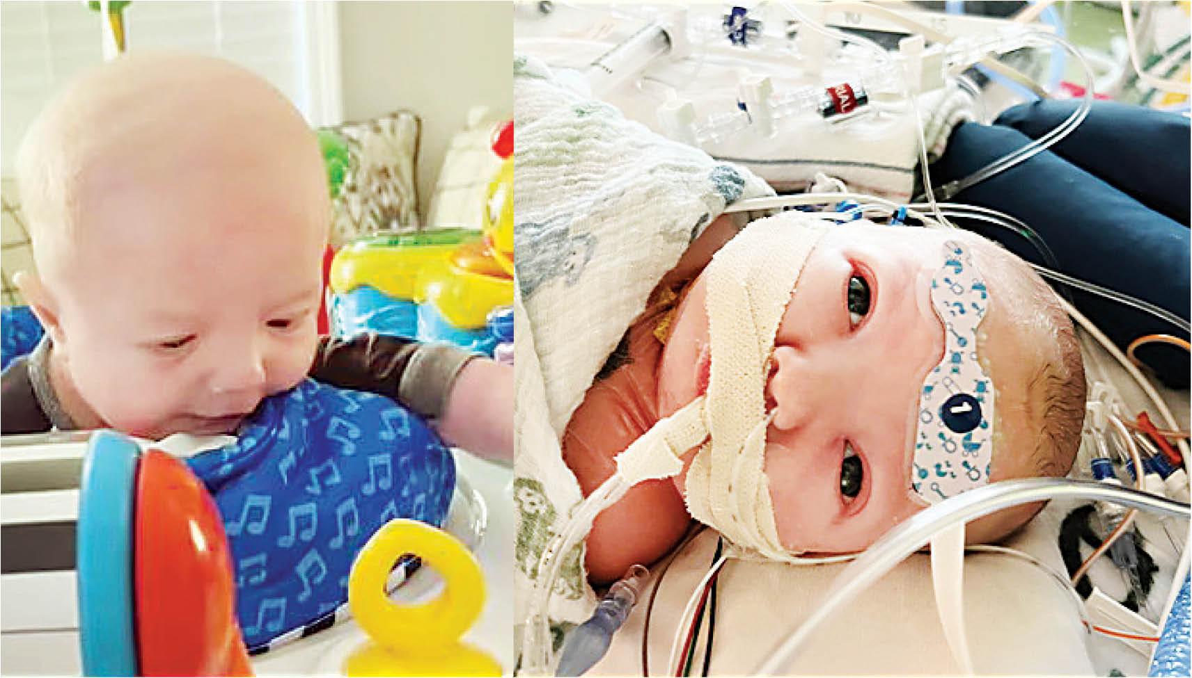 نجات نوزاد با نخستین پیوند بافت زنده قلب