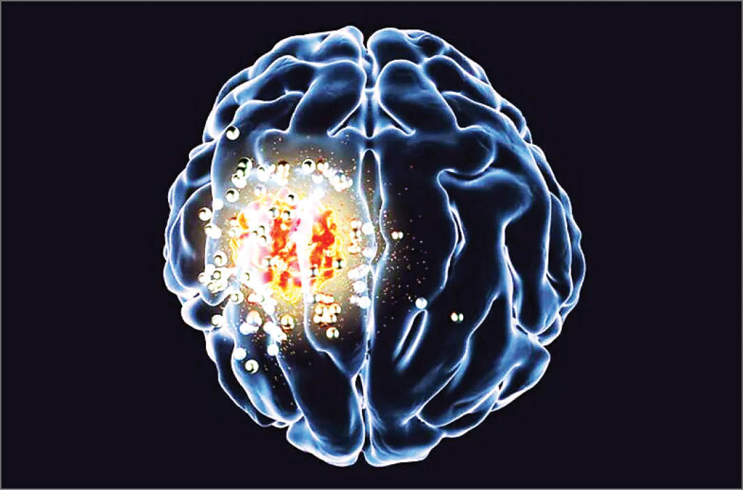 نابودی تومورهای مغزی با یک دستگاه بی‌سیم