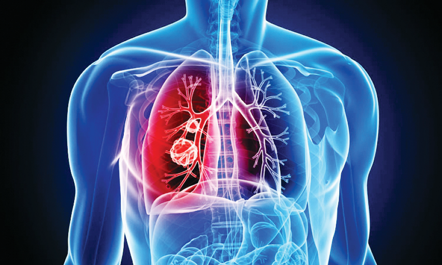 تعجب دانشمندان از قدرت تکامل سرطان ریه
