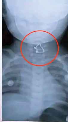 نجات از فنر مرگبار!