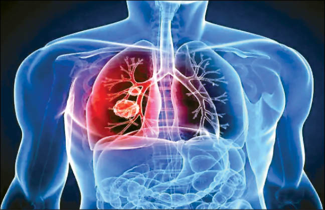 کاهش ۴۱ درصدی احتمال مرگ با واکسن جدید سرطان ریه