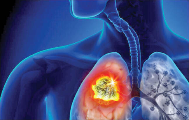 شیوع بالای سرطان ریه در زنان