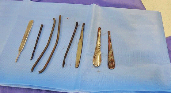 خارج کردن 4دسته قاشق از شکم مرد شیشه‌ای