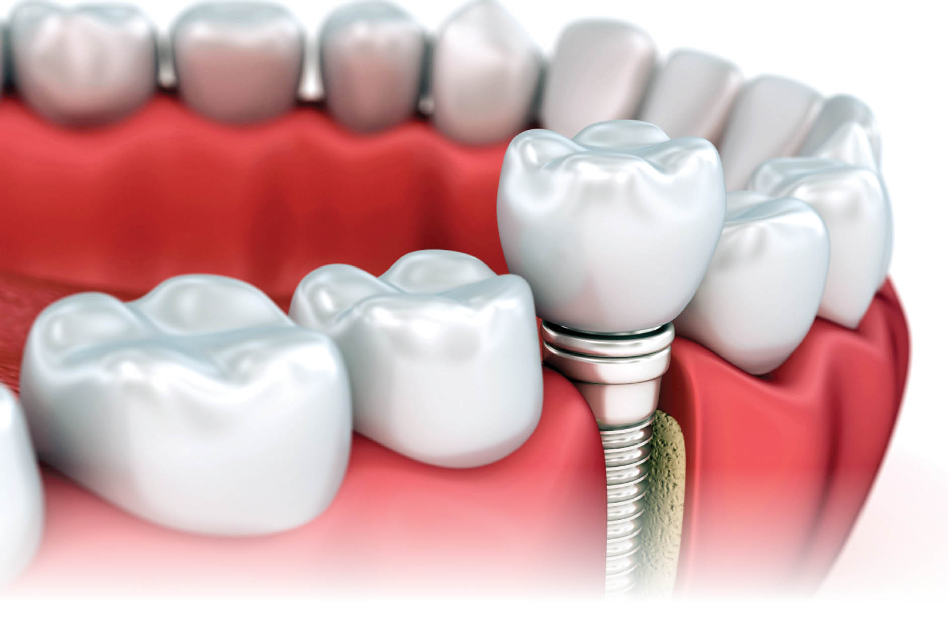 کاشت دندان مناسب همه نیست