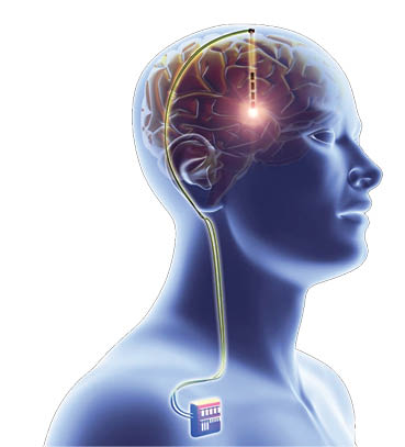تراشه‌ای برای درمان سردرد